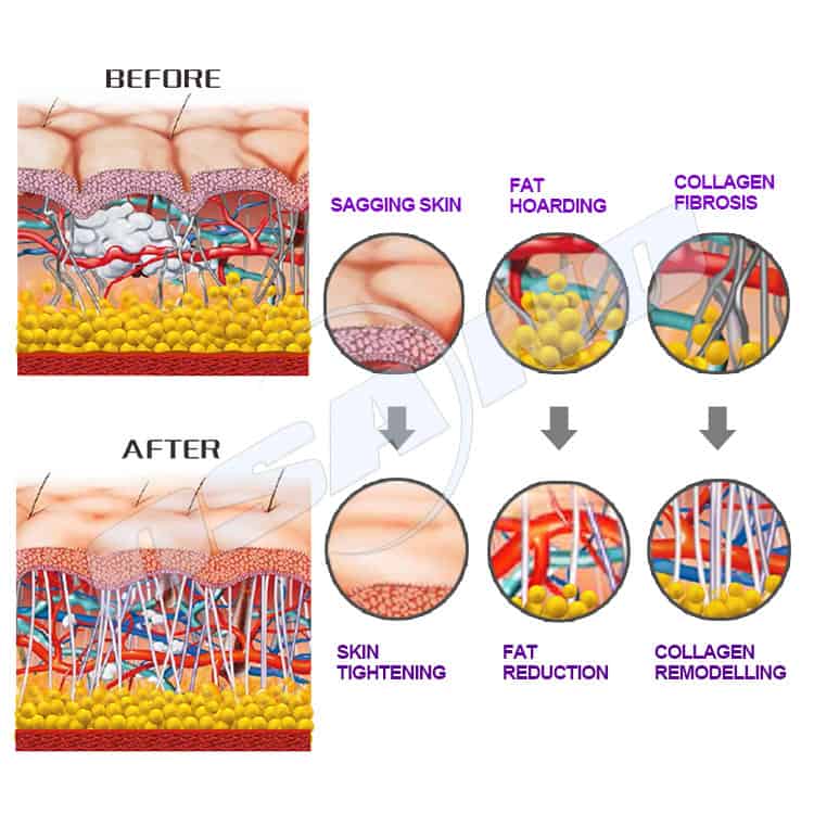 Αγοράστε Συσκευή περιγράμματος σώματος RF Vacuum Rollers Therapy Skin Tightening Shock Wave Therapy στην Guangzhou OSANO Beauty Equipment Co.,Ltd.