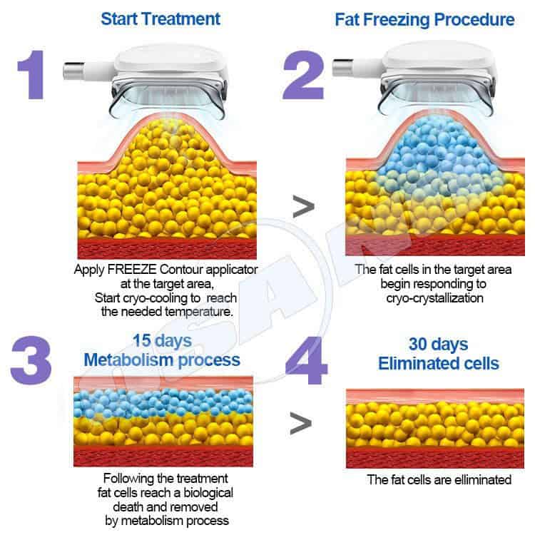 Een vetbevriezingsproces in 4 stappen met de innovatieve 360 draagbare cryotherapiemachine: starten, bevriezen, metabolisme in 15 dagen, vetcellen elimineren in 30 dagen.