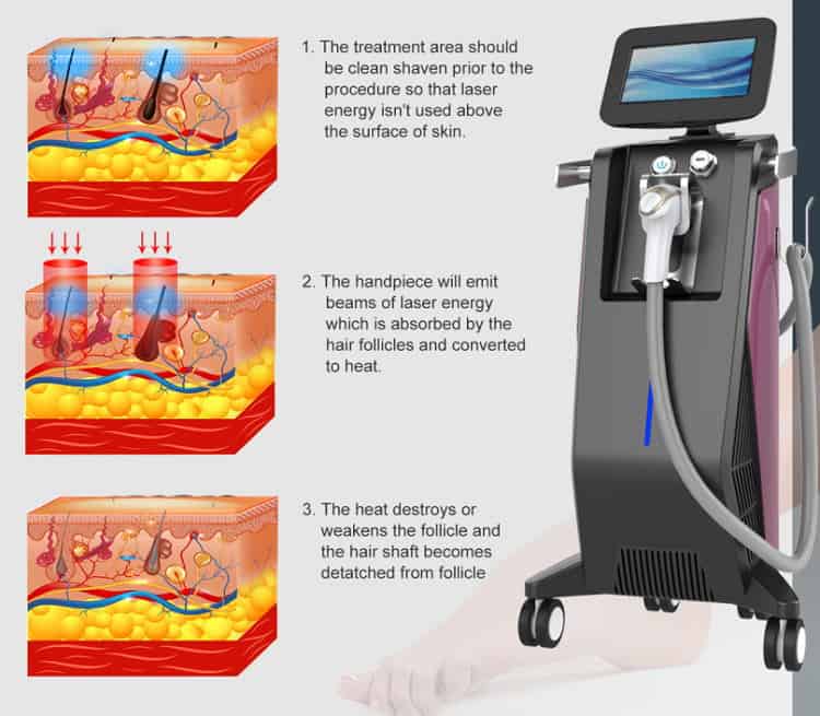 Gold Standard 808 Diode Laser Hair Removal Machines For Sale
