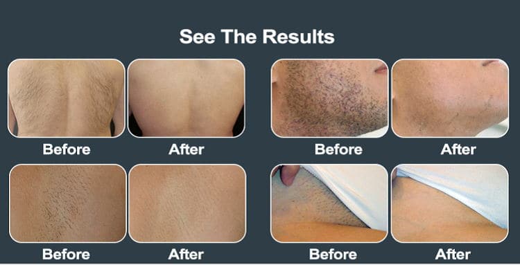 Gold Standard 808 Diode Laser Hair Removal Machines For Sale