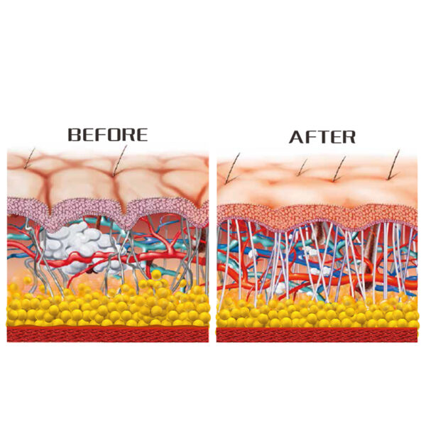 Immagine prima e dopo il trattamento della pelle con una macchina per terapia a onde piezoelettriche portatili.