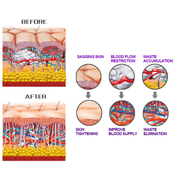 A diagram showcasing various stages of a skin treatment, featuring the Best Shockwave Therapy Machine For Home Use.