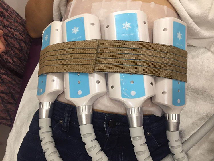 Een vrouw ligt op een bed met de nieuwe draagbare elektromagnetische schokgolf-cryotherapie DIY-schokgolftherapie-machine eraan vastgemaakt.
