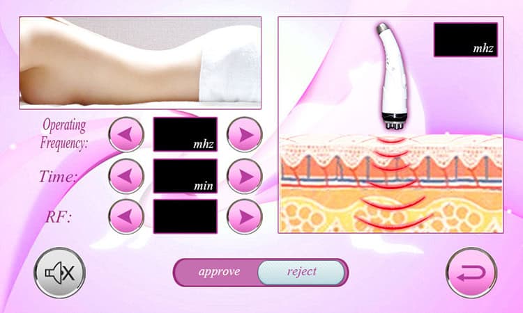 초음파 캐비테이션 Rf 무선 주파수 지방 요법 미용 기계 치료를 받고 있는 여성의 신체를 보여주는 화면.