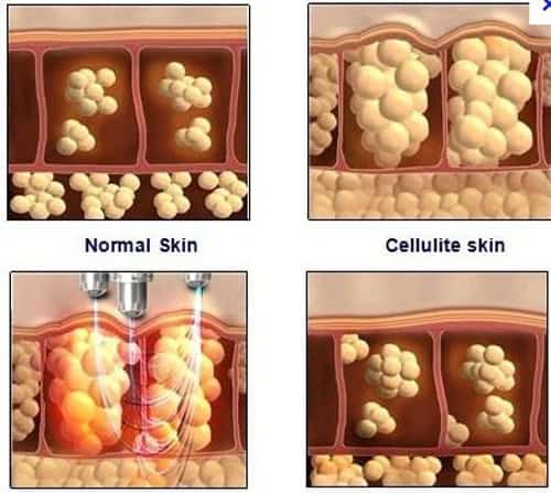 A diagram showcasing the various stages of Cryolipolysis Cyro Machine Fat Loss Therapy Without Side Effects treatment for fat loss using a Cyro Machine.