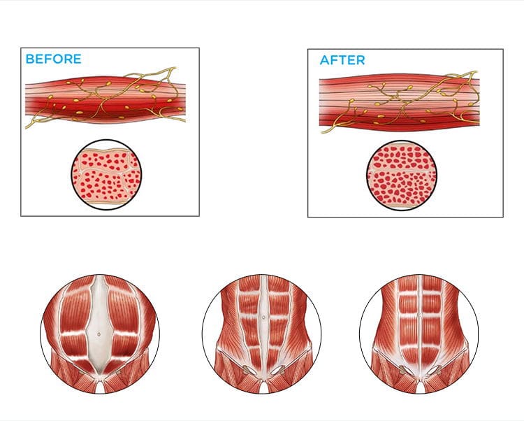 Before and after images showcasing the effects of an Aesthetics Desktop 7 Tesla EMS Slimming Machine on muscles.