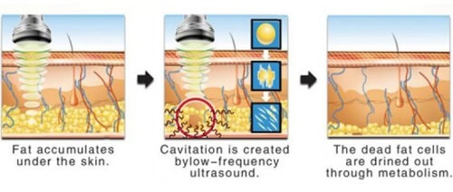 O diagramă care ilustrează procesul de cavitație a grăsimilor, care încorporează aparatul de înfrumusețare pentru terapie lipoterapie cu radiofrecvență cu ultrasunete.