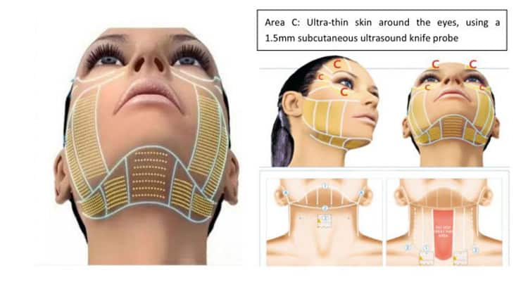 Wajah seorang wanita terlihat sedang menjalani perawatan dengan Mesin Hifu Portabel 4 In 1 Terbaik.