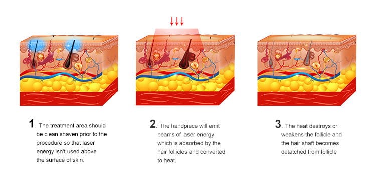A diagram illustrating the stages of a skin treatment using the OSNAO Permanent E Light Professional IPL Machine.