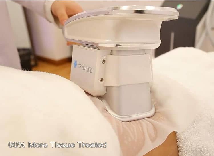 Una mujer está siendo tratada con el mejor gel adelgazante para máquina de cavitación en un hospital.