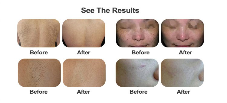 Uma foto impressionante de antes e depois mostrando os efeitos transformadores do tratamento de pele OSNAO Permanent E Light Professional IPL Machine.