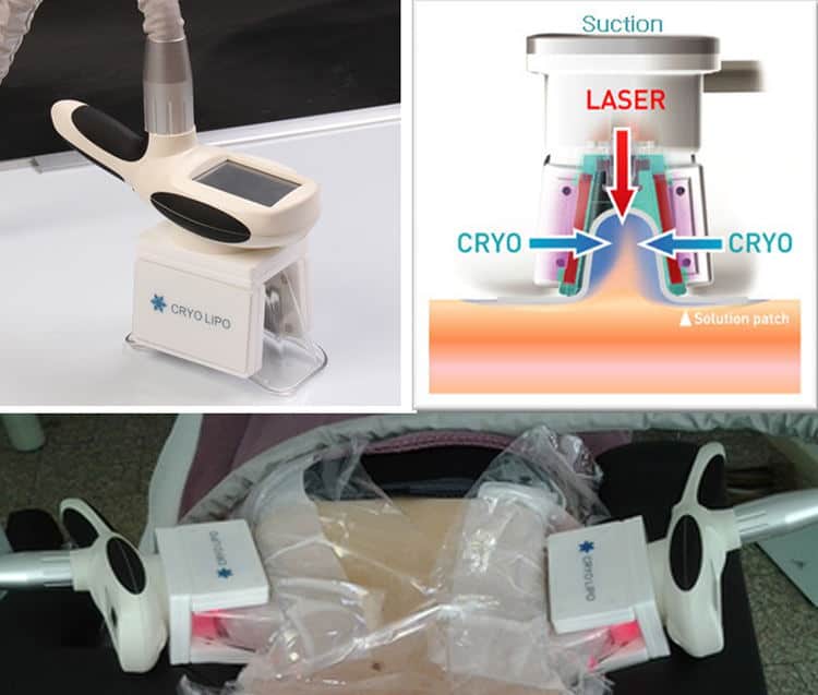 To billeder af "Bedste slankegel til kavitationsmaskine", der bruges til hårfjerning på en persons krop.