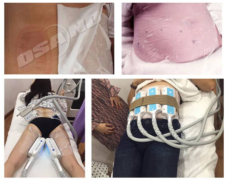 Kavitasyon Makinesi İçin En İyi Zayıflama Jeli ile tedavi edilen bir kadının dört fotoğrafı.
