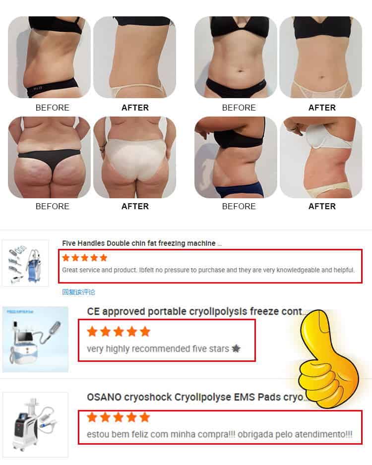 Et billede af en kvinde post-Best Home Equipment Full Body Cryotherapy Cryolipolysis Cellulite Tab Treatment Cryo Weight Loss Machine, der viser resultaterne af cellulite reduktion.