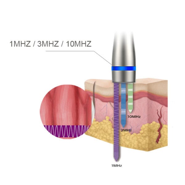 The Professional Multifunction Ultrasound 3-10 mhz Beauty Salon Best Non-surgical Wrinkle Treatment Microcurrent Device For Face is the best device for face treatment that utilizes microcurrent technology to rejuvenate the patient's skin.