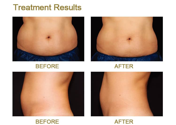 A remarkable transformation can be seen with the use of a Professional Skin Rejuvenation Mono Polar Radio Frequency Fat Reduction RF Body Sculpting Machine, showcasing the impressive before and after results of a tummy tuck treatment.