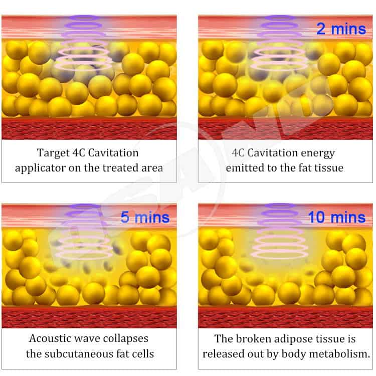 Diagram yang menggambarkan berbagai tahap kavitasi ic dalam kaitannya dengan Mesin Penghilang Selulit Pelangsing Tubuh Slim Beauty.
