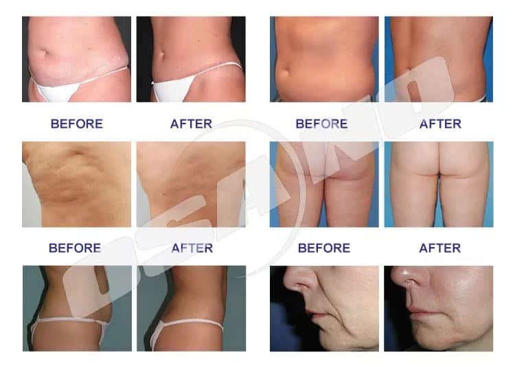 Фотографии до и после подтяжки живота с использованием аппарата 3D-кавитации Velasmooth для коррекции фигуры, выставленного на продажу.
