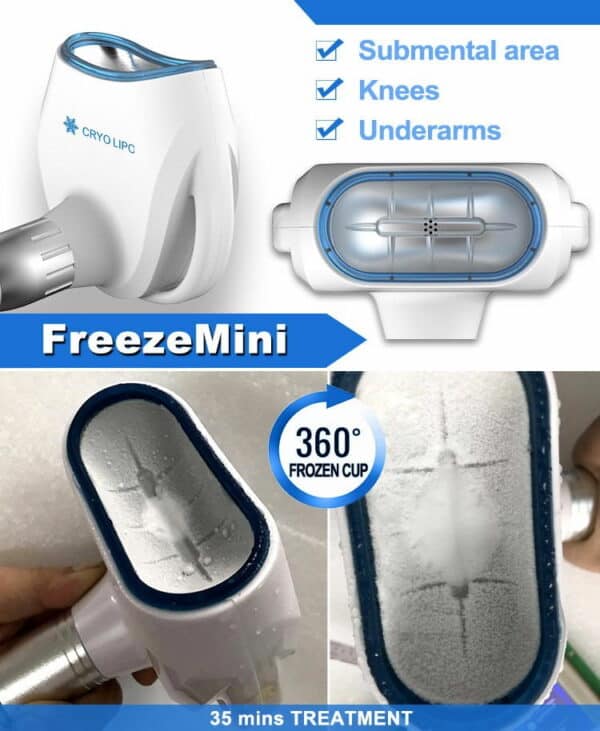 A portable device called the OSANO portable mini remove double chin cryotherapy therapy machine for face that uses cryotherapy to remove double chin.