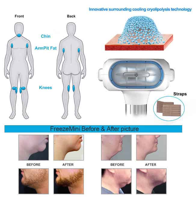 Портативная схема, иллюстрирующая различные этапы работы портативного мини-аппарата для криотерапии OSANO для удаления двойного подбородка для удаления волос на лице.