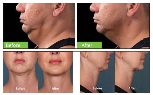 Pirms un pēc tauku atsūkšanas OSANO portatīvais mini noņemšanas dubultzoda krioterapijas aparāts sejai efektīvi noņem sievietes dubultzodu, atstājot viņai gludāku kakla kontūru.