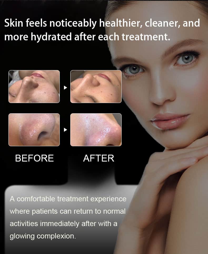 De huid voelt na elke behandeling gezonder en gehydrateerder aan met de Desktop Facial Skin Blackhead Remover Machine Rejuvenation multifunctionele huidverzorgingsmachine.