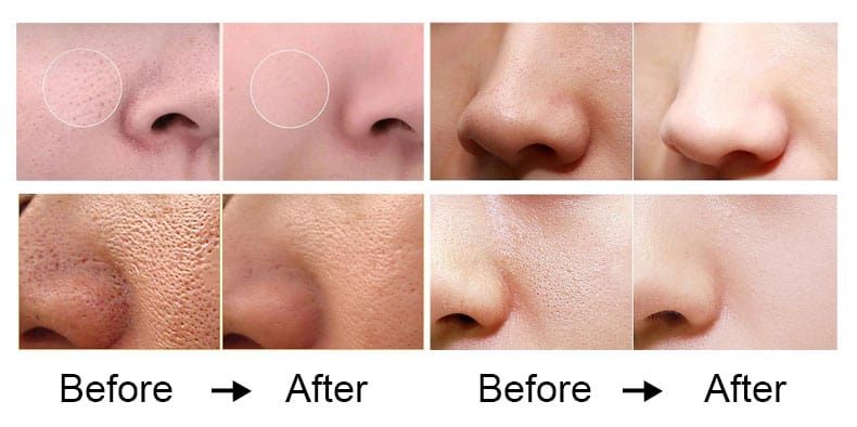 Voor en na foto's die de transformatieve effecten laten zien van het gebruik van de Desktop Facial Skin Blackhead Remover Machine Rejuvenation Multifunctionele Huidverzorgingsmachine op de neus van een vrouw.