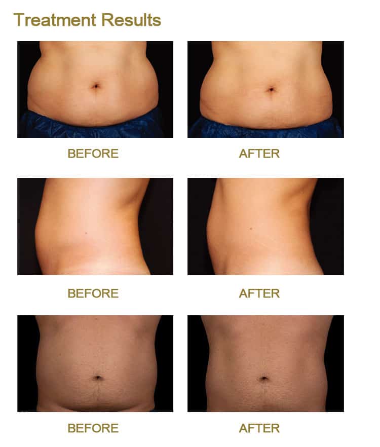 Trusculpt Flex Machine RF Body Slimming Device 3D Body Sculpt Therapy before and after tummy tuck treatment results.