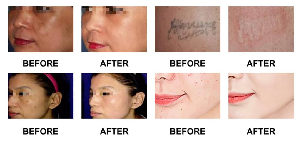 Comparison of before and after skincare treatments on different individuals.