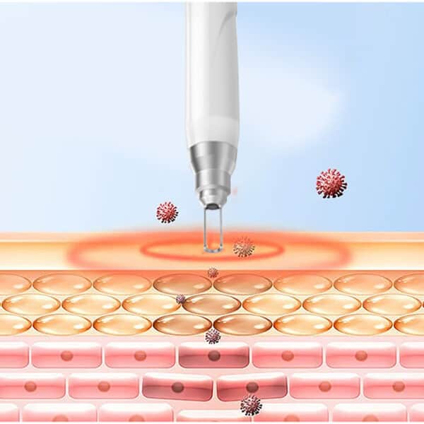 A Picosecond Laser Freckle Tattoo Removal Skincare Honeycomb Aesthetic Q Switch Laser Machine is being used to treat a person's skin.