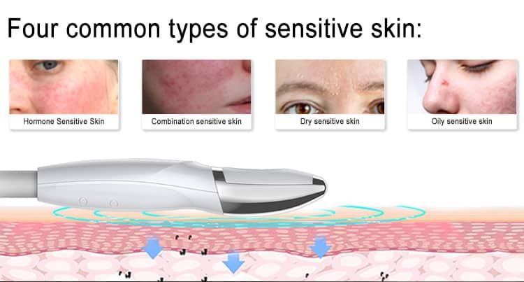 Quattro tipi di pelle sensibile sono raffigurati utilizzando macchine per la cura della pelle sensibile, crioelettroforesi, dispositivo di bellezza, strumenti facciali, sicurezza per spa/clinica/salone.
