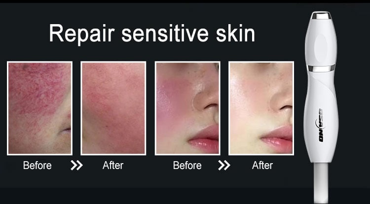 Kép egy Sensitive Skin Care Machines Cryo Electrophoresis Beauty Device készülékről az érzékeny bőr helyreállítására.