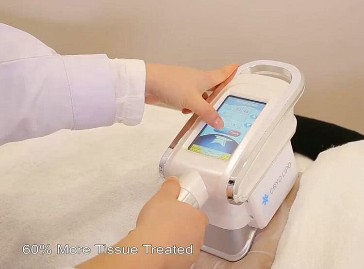 CoolSculpting có giống với Cryolipolysis không? Khám phá sự thật về kỹ thuật đông lạnh mỡ