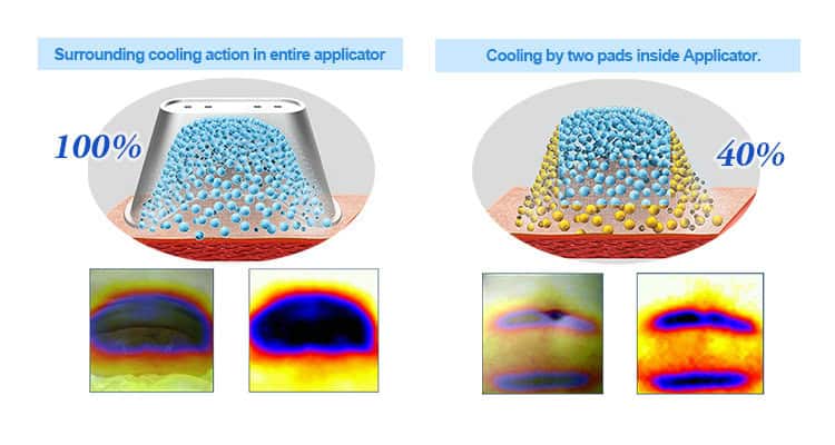 Combien de temps faut-il pour que la cryolipolyse fonctionne ? Le temps nécessaire pour voir les résultats du Coolsculpting