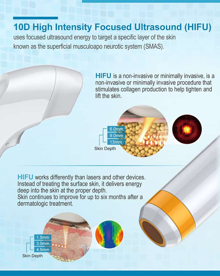 Ilustrație a ultrasunetelor focalizate de înaltă intensitate (HIFU) pentru piele, cu aparatul Hifu 10D, straturi ale pielii și efecte de colagen.