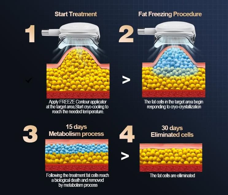 Η διαδικασία BodySculpting 4 βημάτων περιλαμβάνει ψύξη, πρώιμη απόκριση των λιποκυττάρων, μεταβολισμό 15 ημερών και αποβολή λιποκυττάρων 30 ημερών.