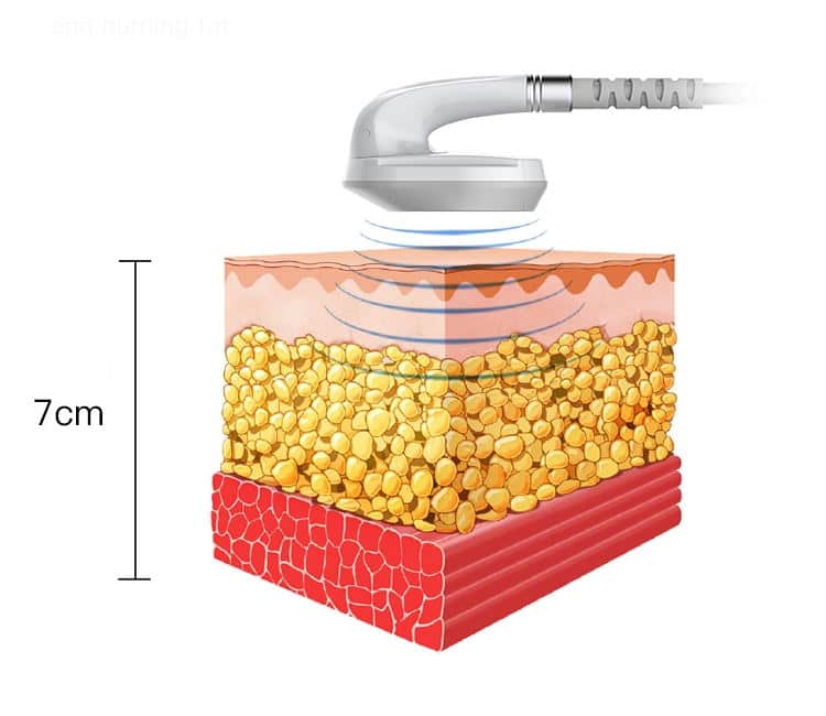 Illustration of a device targeting subcutaneous fat in skin layers for slimming. Includes 7 cm scale. Product: New 4 Handles BodySculpting Machine.