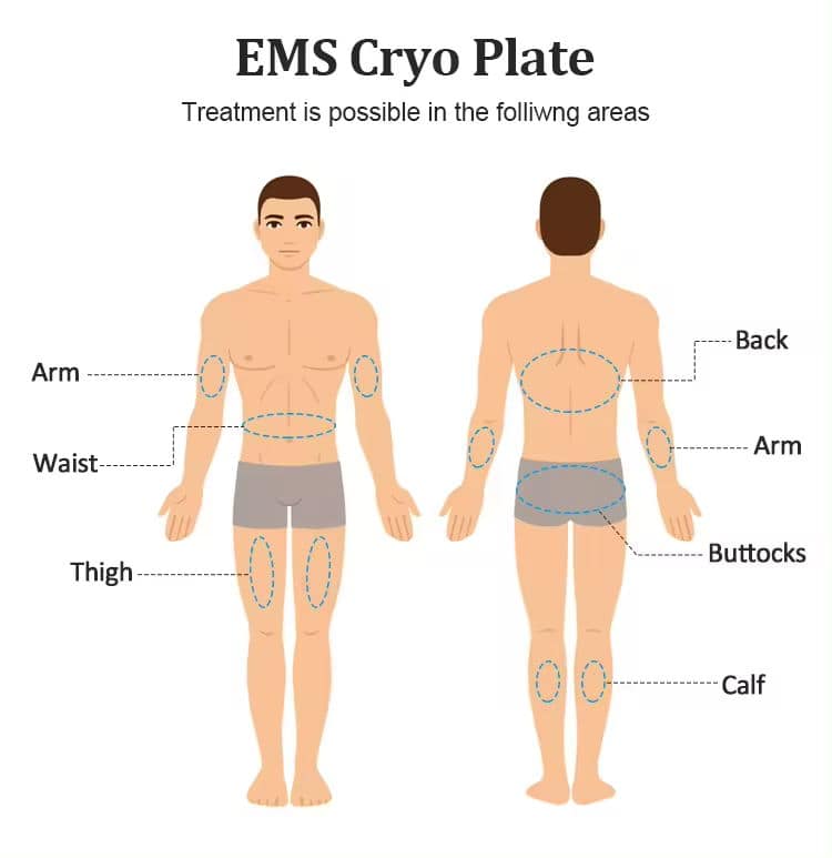 Diagram van het mannelijk lichaam dat gebieden benadrukt voor vetverlies door Cryolipolyse: armen, taille, dijen, rug, billen, kuiten met behulp van een krachtige 8 cryo-handgreep.