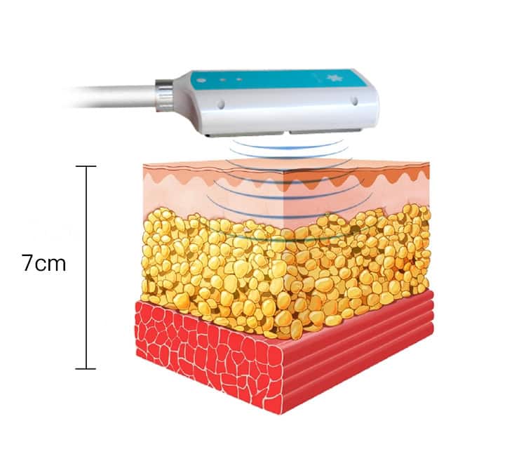 Illustratie van het krachtige apparaat met 8 cryohandvatten dat zich richt op vetcellen voor cryolipolyse op een diepte van 7 cm – ideaal voor effectieve behandelingen voor vetverlies.