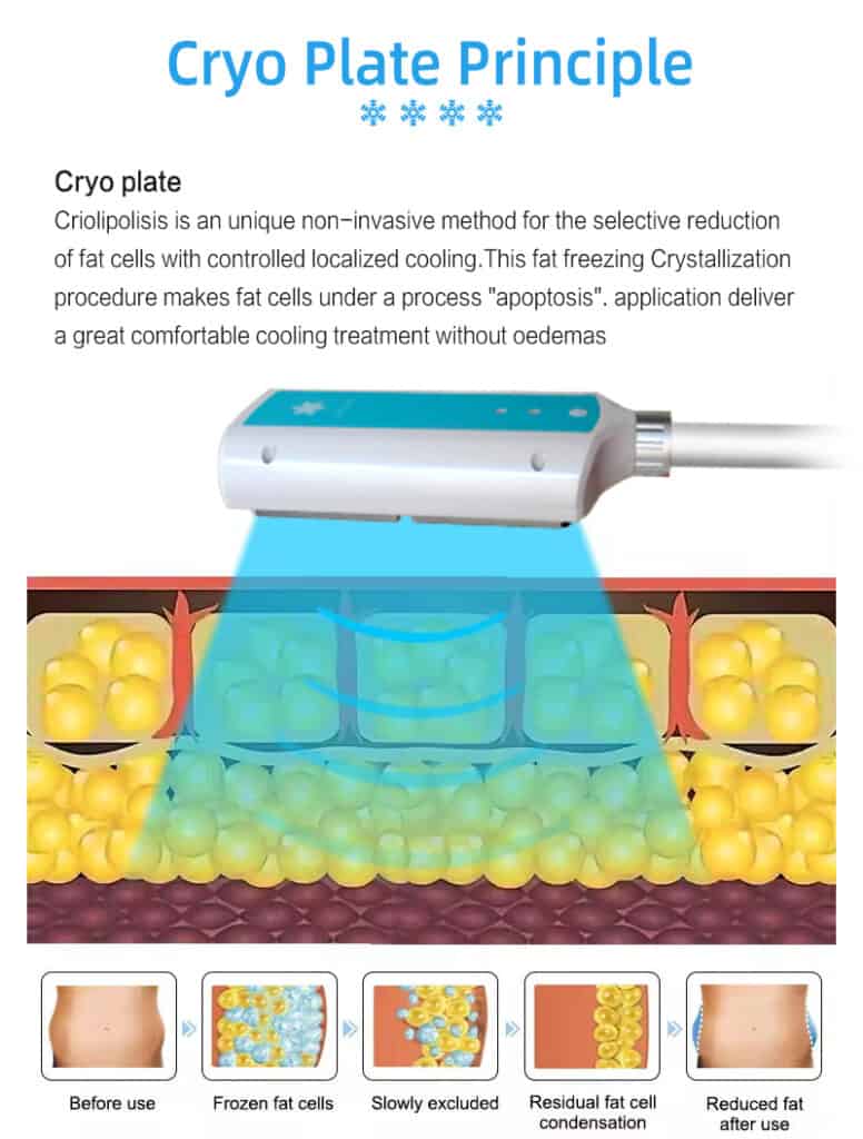 Het diagram "Cryo Plate Principle" toont cryolipolyse: vetcellen worden afgekoeld, kristalliseren en worden geëlimineerd zonder weefsel te beschadigen. Deze techniek maakt gebruik van de krachtige 8 Cryo Handle Body Sculpting Machine voor effectief vetverlies.