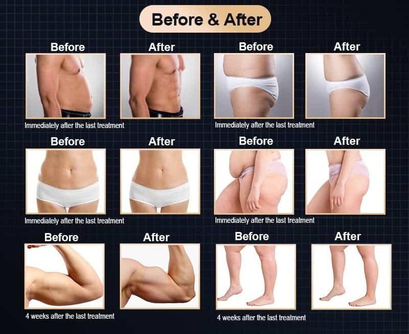 See before-and-after photos showcasing a 4-week BodySculpting EMS treatment on abdomen, waist, thighs, arms, and legs with visible results.