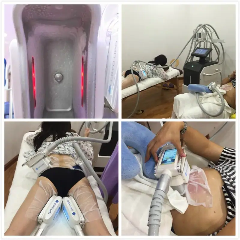 Patient undergoing CoolSculpting treatment with OSANO Freeze Contour MAX device in a clinical setting.
