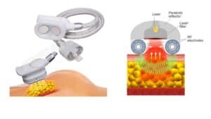 Illustration of a medical device using laser, RF electrodes, and ultrasound to treat fat cells beneath the skin. The diagram shows safety components.