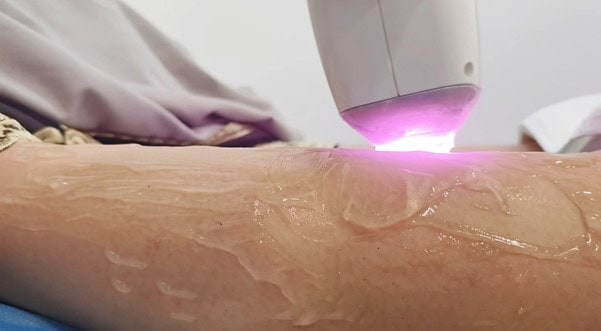 Um dispositivo que emite luz roxa, como um laser de Alexandrite, é usado em um braço coberto de gel.