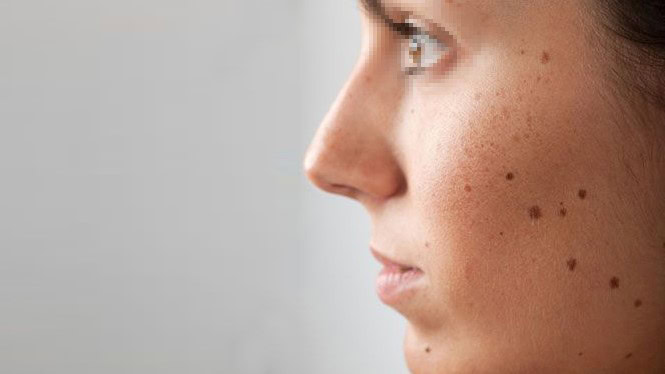 Yüzünde birden fazla güzellik beneği bulunan, tarafsız bir şekilde ileriye bakan kişi.