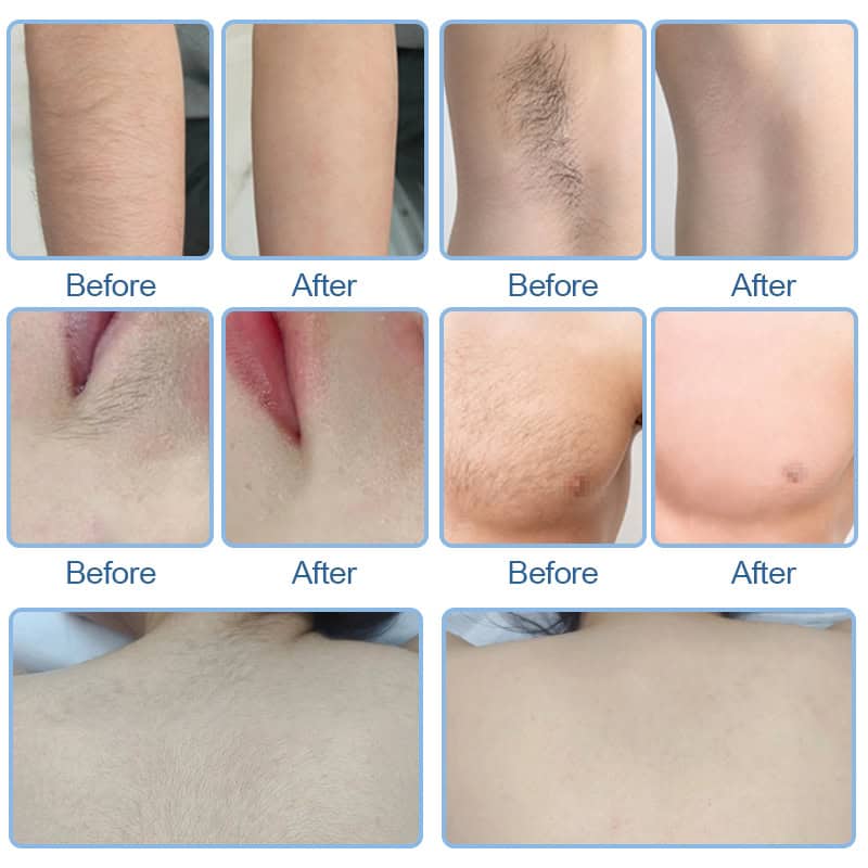 Se før/efter billeder af reduceret kropshår på flere områder med Ice Diode Laser hårfjerningsmaskinen.