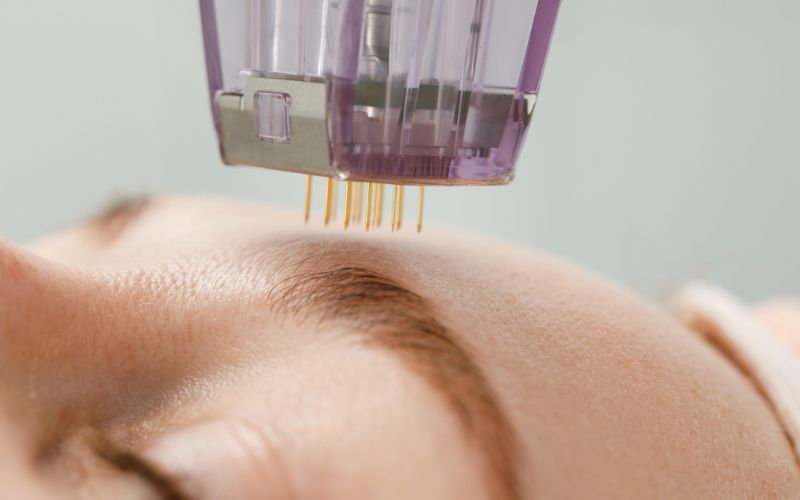 Microneedling device performing facial treatment on a person's skin for skincare and rejuvenation.
