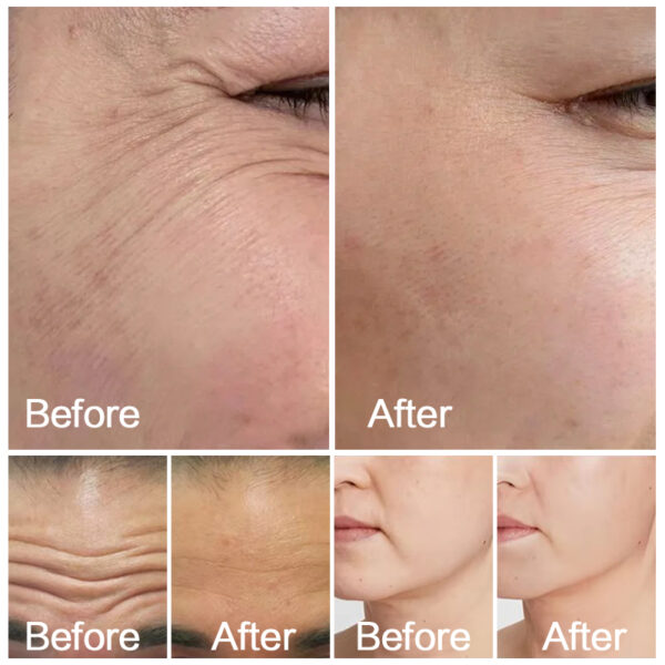 Advanced Face Lift Machine for Non-Invasive Facial Anti-Aging From Osano