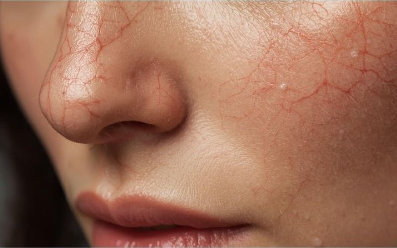 Close-up image of facial spider veins highlighting small, dilated blood vessels on the cheek and nose area, illustrating common facial vascular conditions related to skin health and aging.