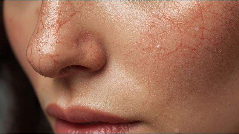 Close-up of facial spider veins showing red, broken capillaries on the cheek and nose area, highlighting common facial vascular issues related to spider veins.